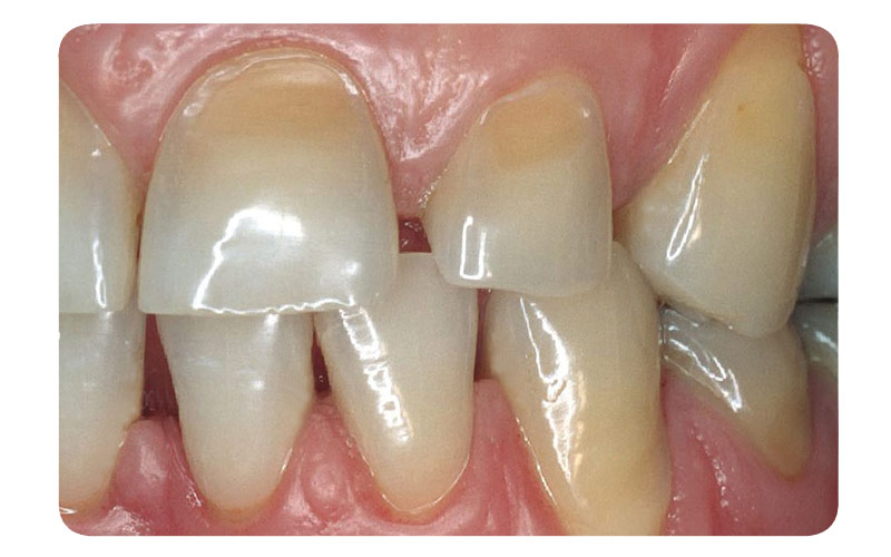 Top 14 comment renforcer l'émail des dents